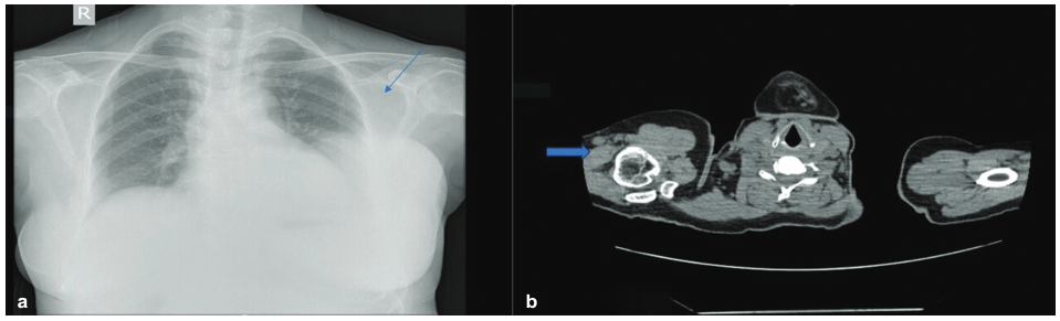 (a) Chest X-ray showing a radiodense lesion in the left breast (blue arrow). (b) Computed tomography (CT) of the thorax showing an isoechoic lesion in the left breast (blue arrow).